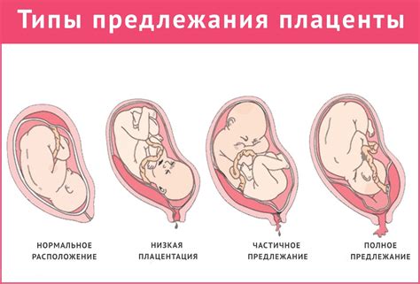 Влияние размещения плаценты высоко по задней стенке на беременность и роды