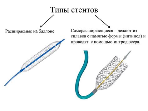 Второй метод: стентирование через ногу