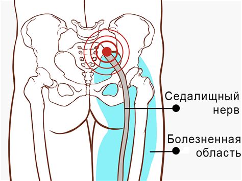 Где находится седалищный нерв?