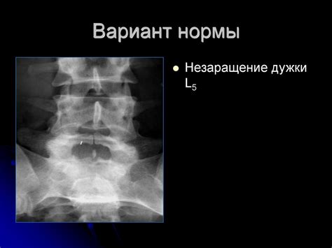 Причины незаращения дужки S1 позвонка у взрослых