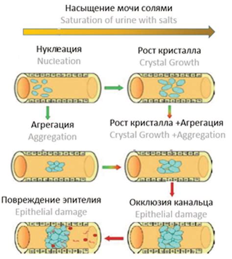 Риск образования мочевых камней