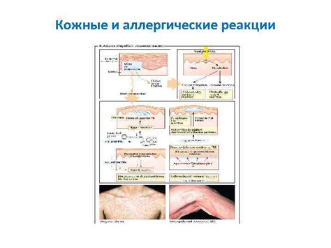 Аллергические реакции и кожные заболевания