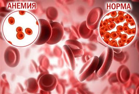 Анемия и недостаток гемоглобина