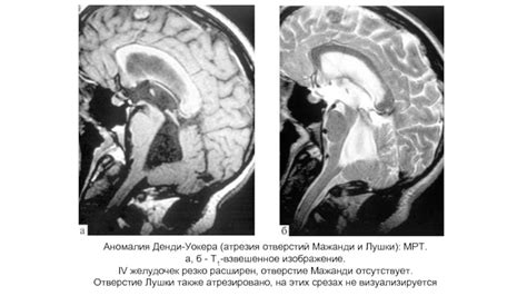 Атрезия отверстий мажанди и лушки