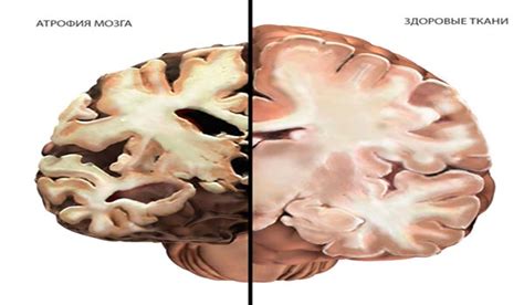 Атрофия мозга из-за длительного отсутствия кислорода