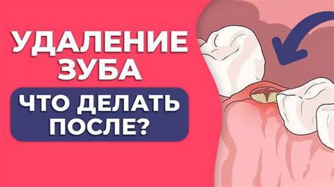 Важные аспекты ухода за полостью рта после удаления зуба с глубоко расположенным корнем