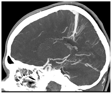 Венозная ангиома головного мозга