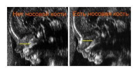 Визуализация носовой кости у плода