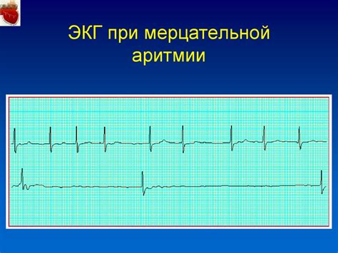 Влияние образа жизни на проявление мерцательной аритмии