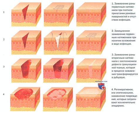 Влияние процесса заживления ран