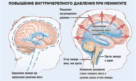 Внутричерепное давление и простое давление: различия