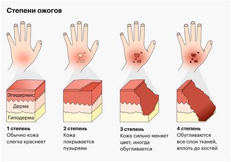 Волдырь от ожога маслом: советы по уходу