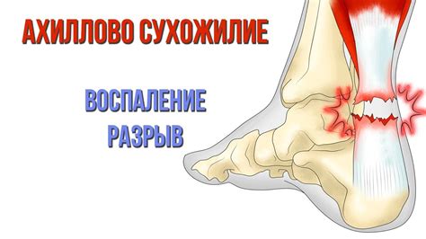 Воспаление ахиллова сухожилия