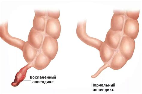 Воспаление вермиса аппендикса: причины и лечение