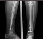 Восстановление после остеосинтеза голени штифтом