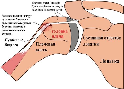 Восстановление после разрыва сухожилия в плечевом суставе