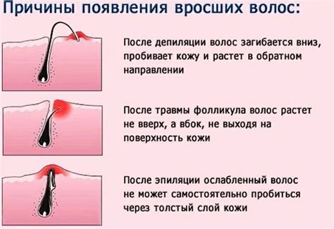 Вросшие волосы: избавление от неприятности