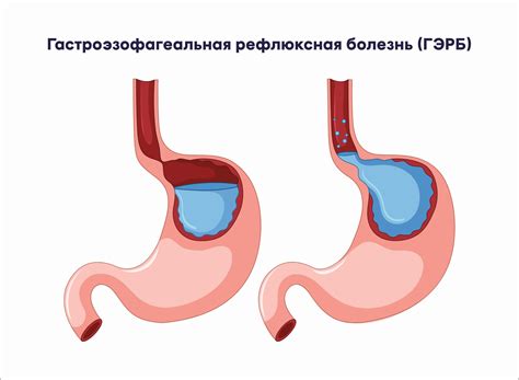 Гастроэзофагеальная рефлюксная болезнь и ФГДС