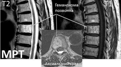 Гемангиома тела th11 позвонка