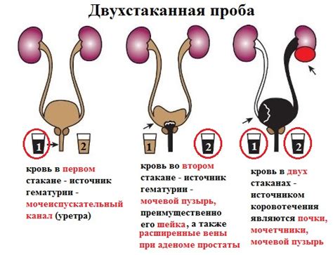 Гематурия у мужчин пожилого возраста