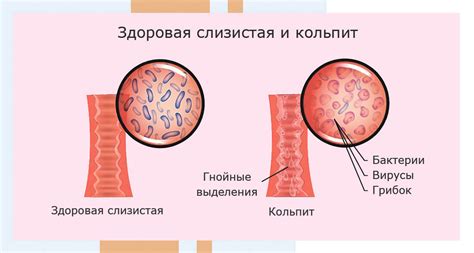 Гинекологическое заболевание