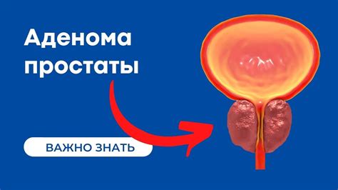 Гиперплазия простаты 1 степени