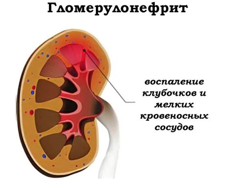 Гломерулонефрит