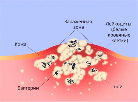 Гнойная рана в сне: предвестник болезни или исцеления?