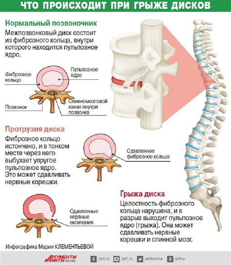 Грыжи в разных отделах позвоночника: симптомы, причины и методы лечения