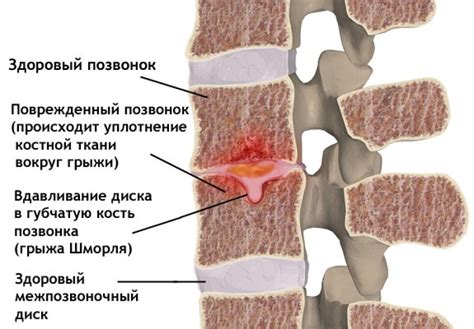 Грыжи шморля в поясничном отделе позвоночника