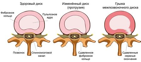 Декомпрессия межпозвоночного диска: новые методы лечения спины