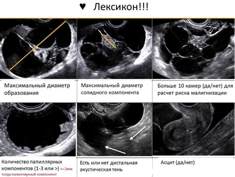 Диагностика ОРАДС 2 яичника