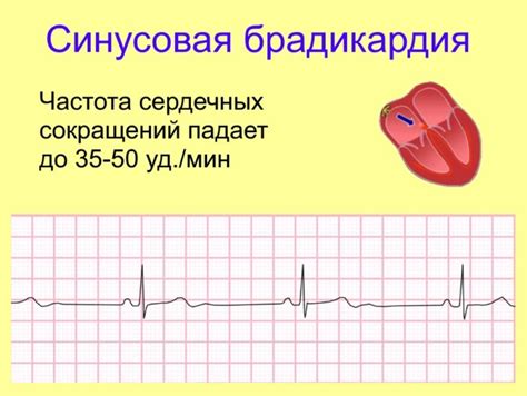 Диагностика выраженной синусовой аритмии у детей