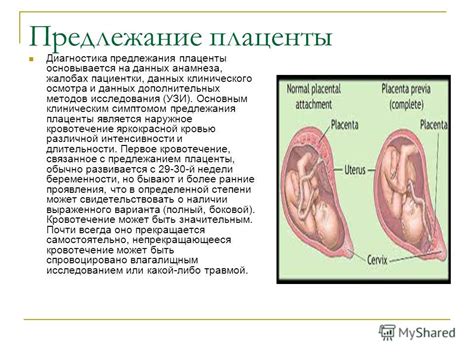 Диагностика высокого положения плаценты