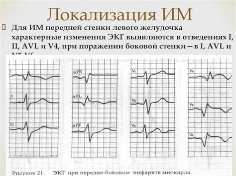 Диагностика гипоксии миокарда по ЭКГ