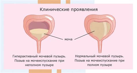 Диагностика макрогематурии мочевого пузыря у мужчин