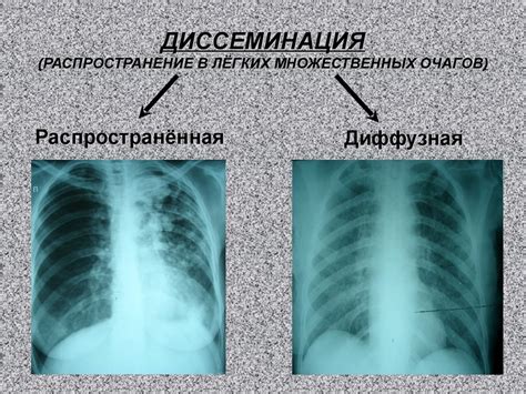 Диагностика множественных очагов в легких