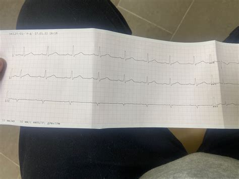 Диагностика отклонения параметров QRS