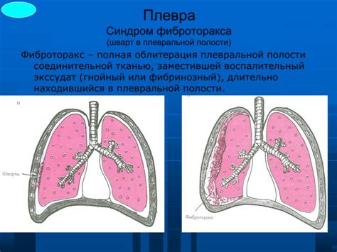 Диагностика плевро-диафрагмальной спайки слева: