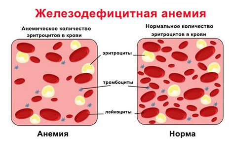 Железодефицитная анемия как возможная причина