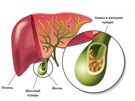 Желчекаменная болезнь