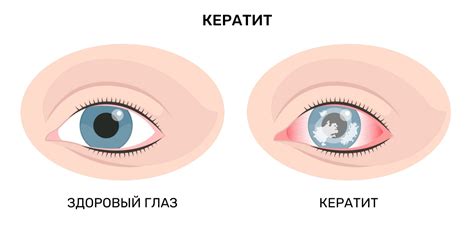 Заболевания глазных оболочек