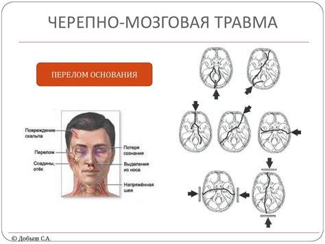 Закрытая черепно-мозговая травма