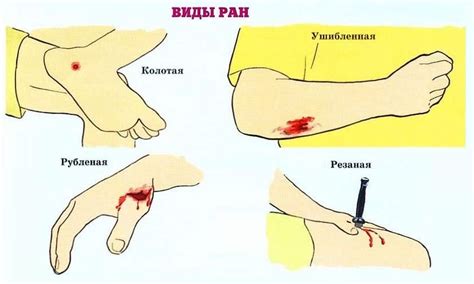 Избегать трения и натирания раны