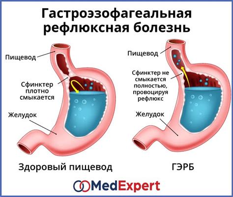 Изжога и рефлюксная болезнь