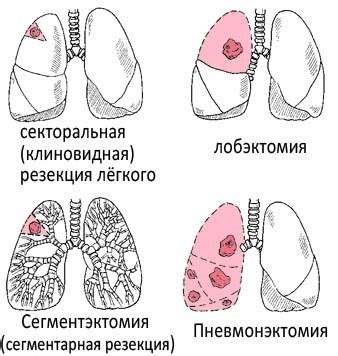 Изменение внешнего вида после удаления нижних ребер у мужчин