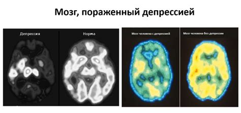 Изменения в пищевом поведении при депрессии