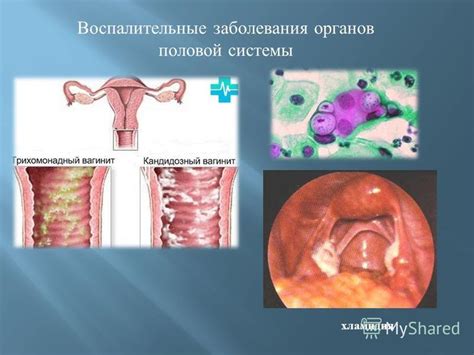 Инфекционные заболевания вагины