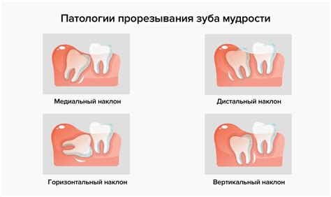 Истолкование сновидения о потере нижнего зуба без пролития крови