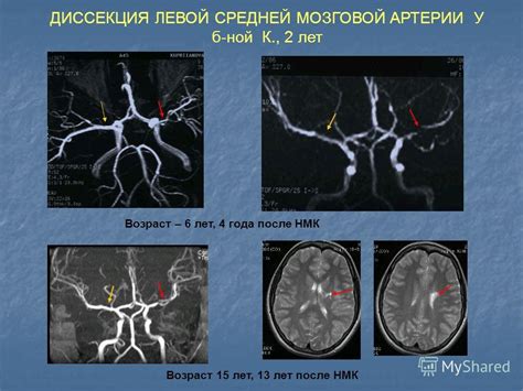 Ишемические нарушения мозгового кровообращения